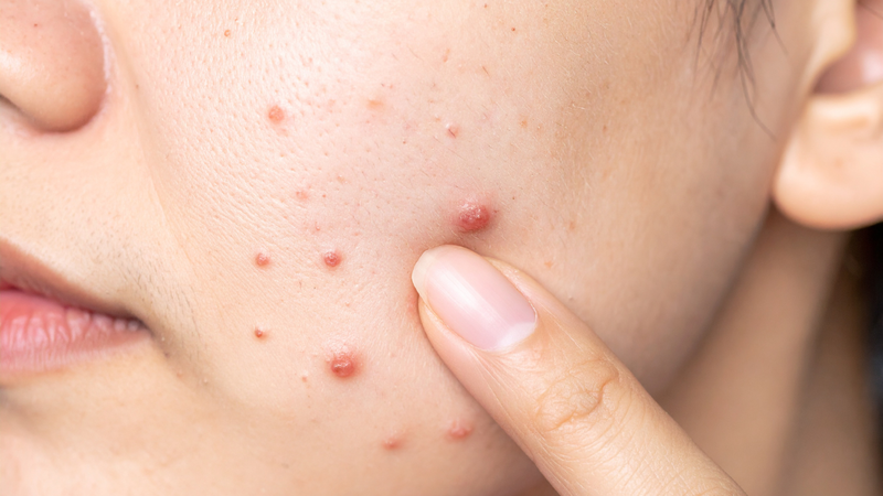 Ăn bánh xèo có nổi mụn không? Đây là thắc mắc của nhiều người