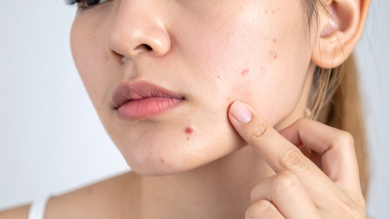 Chế độ ăn uống cũng có thể ảnh hưởng đến làn da