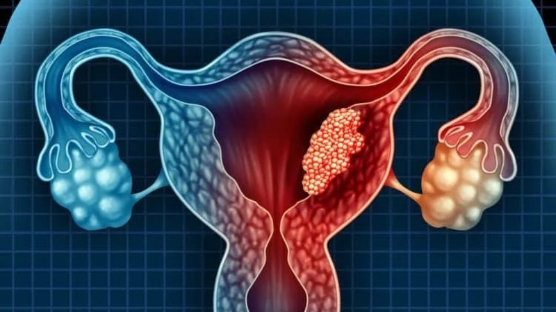 Ấn bụng dưới bên trái thấy cục không đau là dấu hiệu của bệnh gì? 4