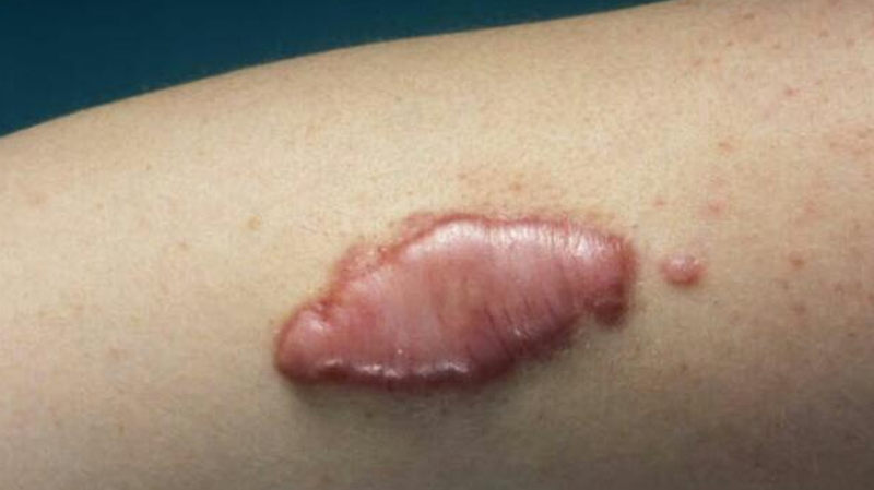 Ăn cá biển có bị sẹo lồi không? Chế độ ăn uống khi có vết thương hở 2