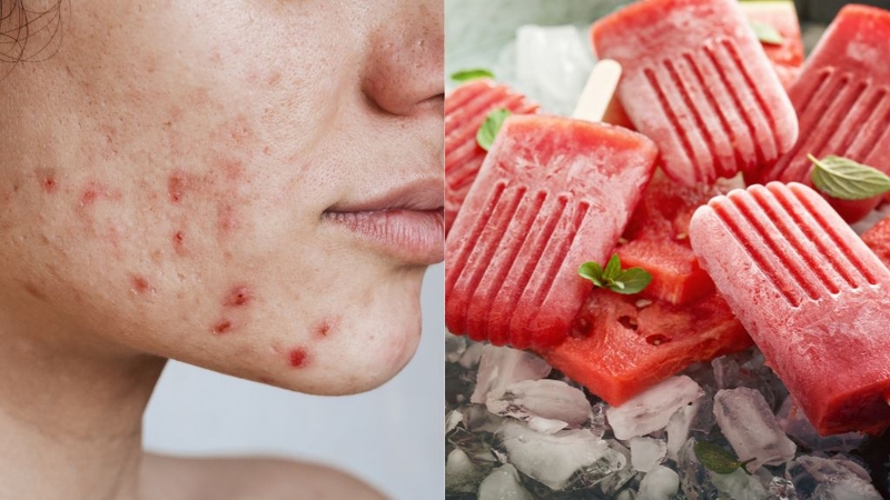 Ăn Dưa Hấu Có Nổi Mụn Không? Có Lưu Ý Gì Khi Ăn? 2