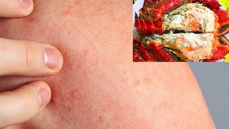 Ăn gạch cua bị say: Nguyên nhân, triệu chứng và cách phòng ngừa hiệu quả 3