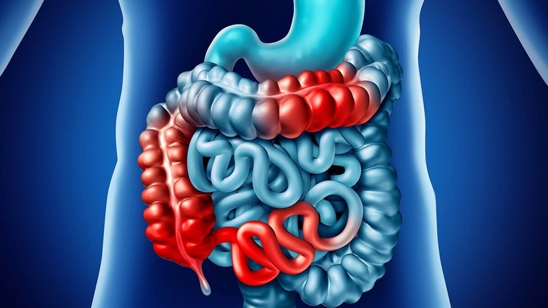 an-gi-tot-cho-benh-dai-trang-nguoi-benh-dai-trang-co-can-kieng-gi-khong 1