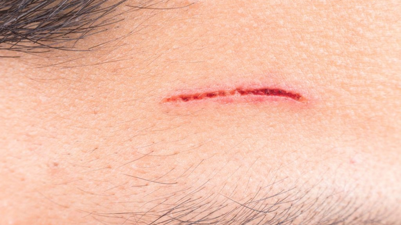 Ăn hải sản có bị sẹo lồi không? 2