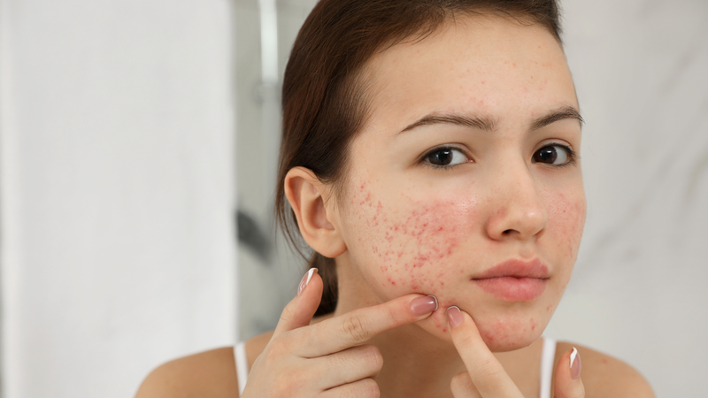 Nguy cơ nổi mụn không chỉ phụ thuộc vào việc ăn hủ tiếu mà còn liên quan đến chế độ dinh dưỡng tổng thể