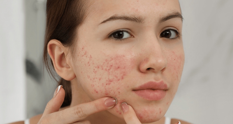 Giải đáp: Ăn nhiều đồ ngọt có bị mụn không? 3