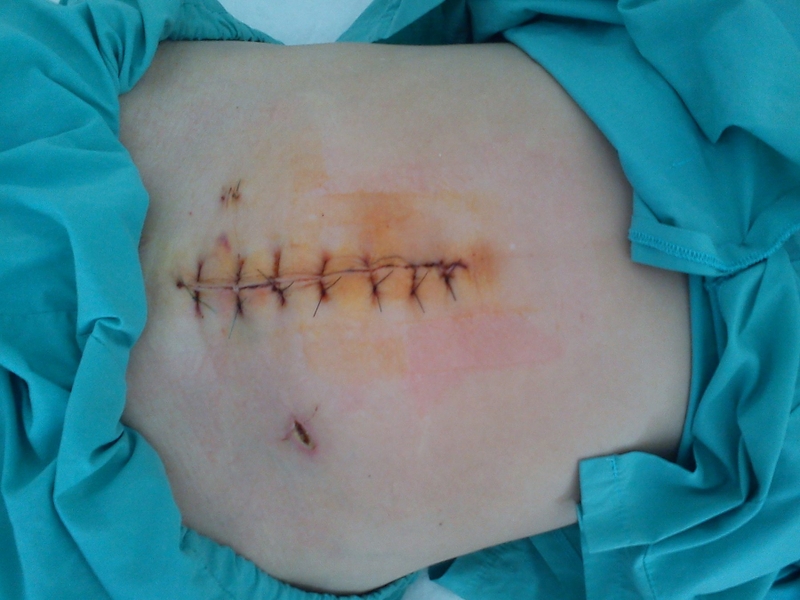 Ăn thịt vịt có để lại sẹo không và nên kiêng thịt vịt bao lâu? 2