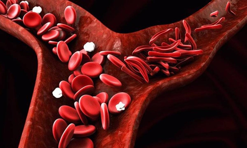 Anemia: Nguyên nhân, dấu hiệu và phương pháp điều trị 1