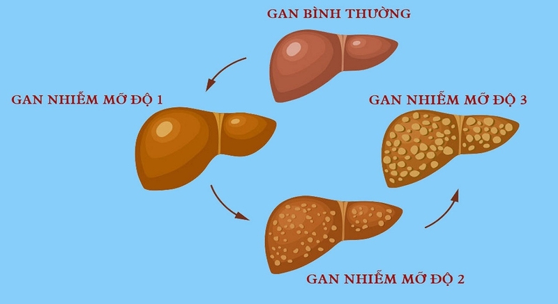 Ảnh hưởng của gan nhiễm mỡ và tiểu đường trong cơ thể chúng ta1