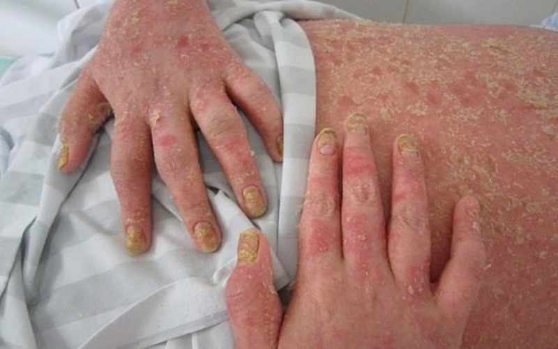 Ảnh hưởng viêm khớp vảy nến đến những cơ quan trong cơ thể con người 1