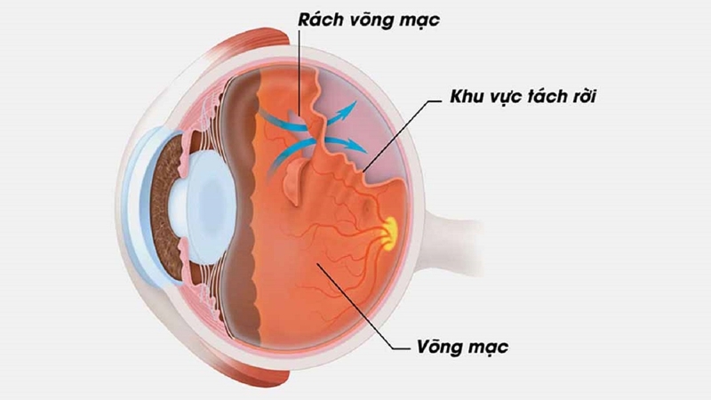 Ánh sáng nhấp nháy tại góc mắt là dấu hiệu của bệnh gì? 2