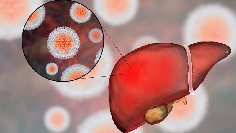Anti-HBc IgM: Xét Nghiệm Quan Trọng Trong Chẩn Đoán Viêm Gan B Cấp Tính 1