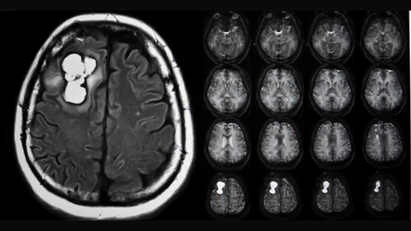Áp lực nội sọ là gì? 4