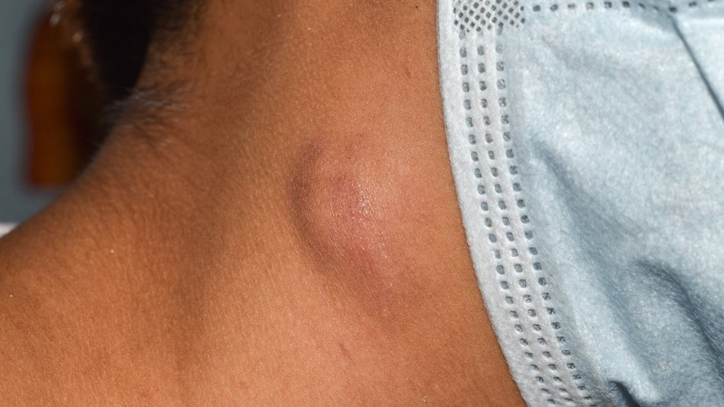 Áp xe cổ: Nguyên nhân, triệu chứng, cách điều trị 1