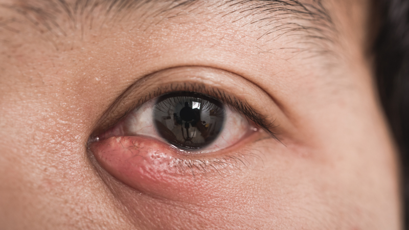 Tổn thương tại chỗ từ các ổ viêm lân cận