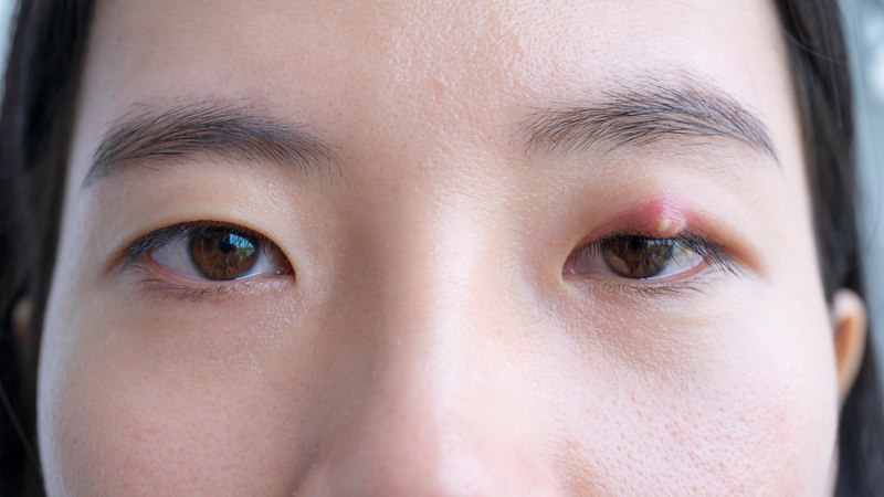 Áp xe mắt thường khởi phát với các biểu hiện rõ rệt tại vùng tổn thương