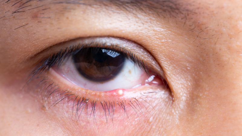 Triệu chứng áp xe mắt tại chỗ làm sưng, đỏ vùng mắt