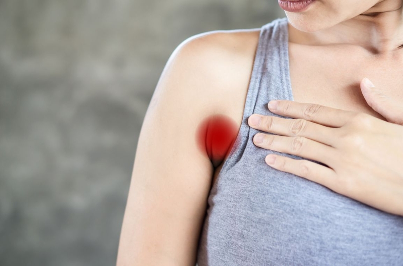 Áp xe nách: Nguyên nhân, triệu chứng, cách điều trị 2