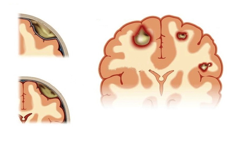 áp xe não do amip 4