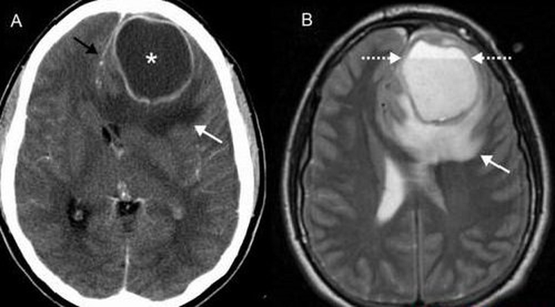 Áp xe là một tổ chức viêm nhiễm, khu trú thành một khối