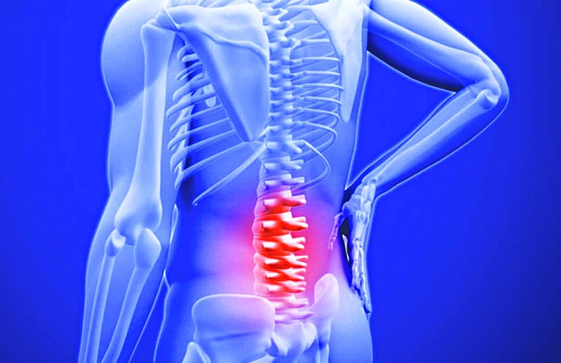 Nhiễm trùng cột sống là một trong những nguyên nhân gây áp xe ngoài màng cứng