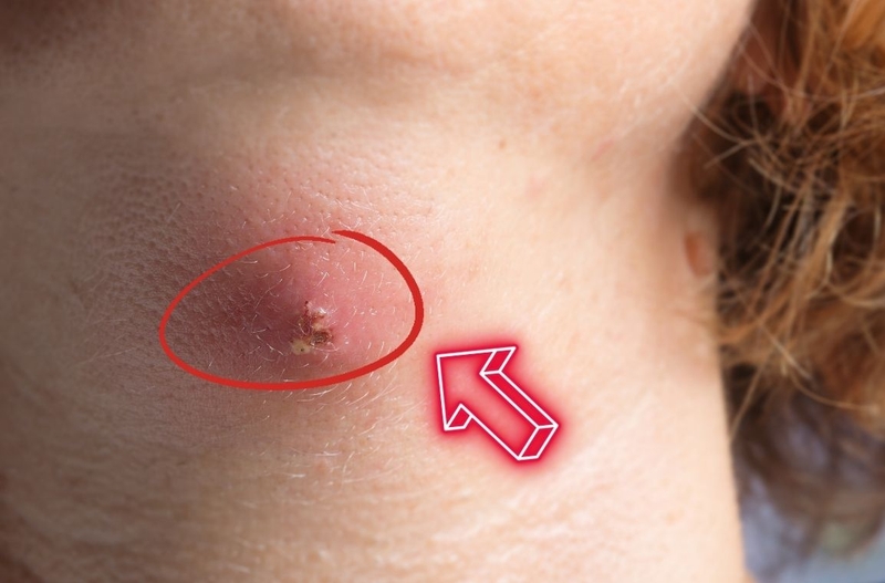 Áp xe nóng là gì? Có gì khác với áp xe lạnh? 1