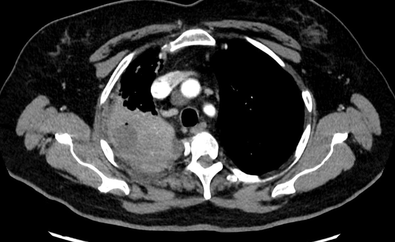 Áp xe phổi có nguy hiểm không? Cách phòng ngừa biến chứng và di chứng 4