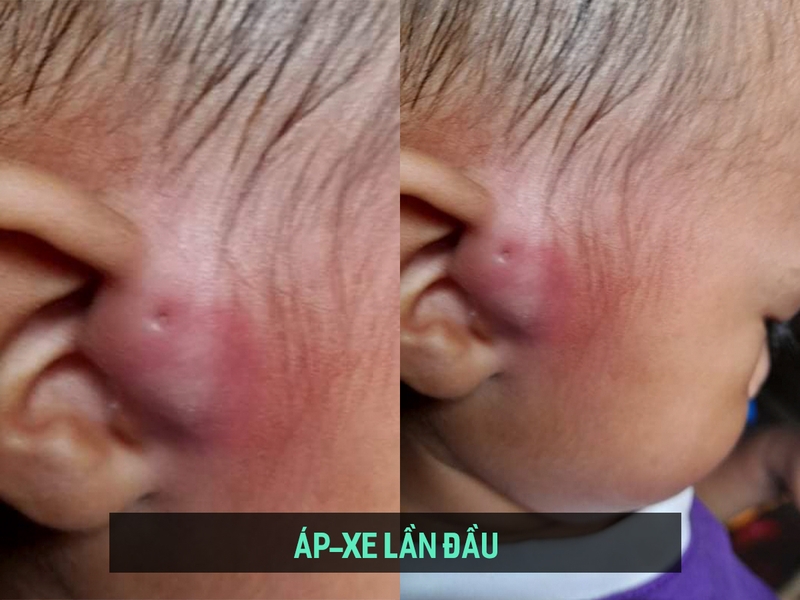 Áp xe rò luân nhĩ 1