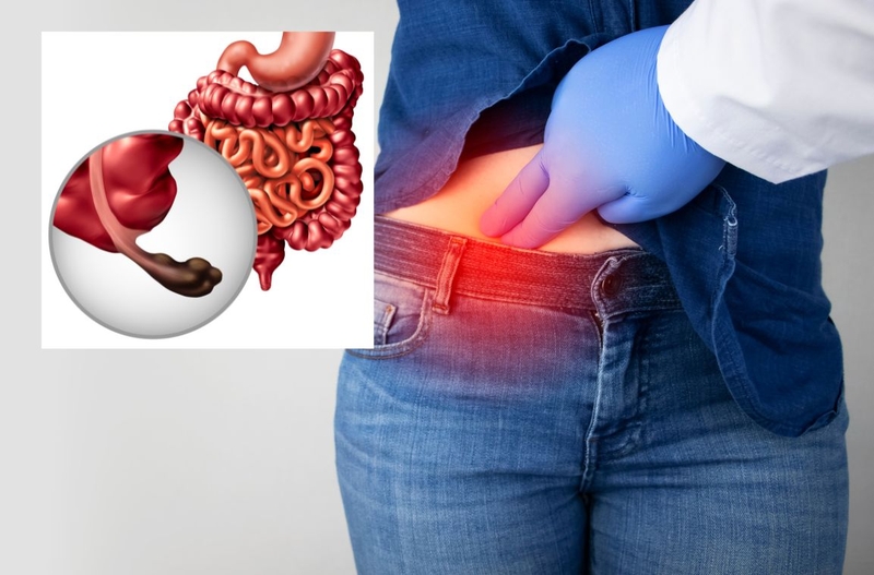 Áp xe ruột thừa: Nguyên nhân, triệu chứng, cách điều trị 1