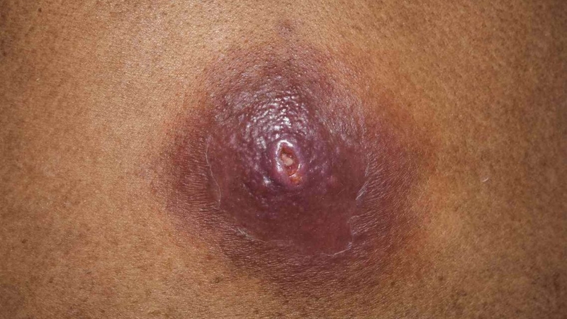 Áp xe vú ở nam giới: Nguyên nhân, triệu chứng, cách điều trị 1