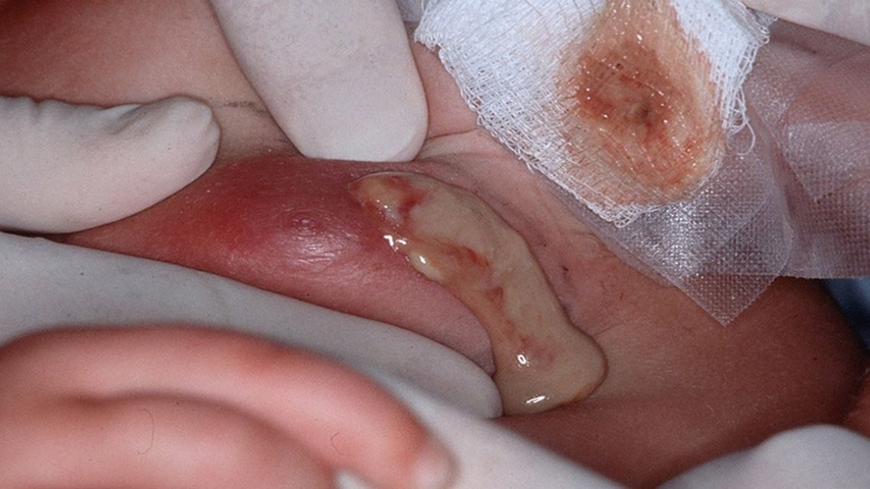 Áp xe vú ở nam giới: Nguyên nhân, triệu chứng, cách điều trị 3