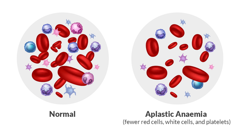 Aplastic anemia là gì? Những biến chứng thường gặp 1