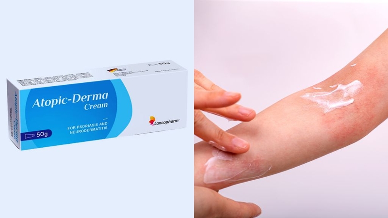 Atopic Derma Cream Lancopharm: Kem dưỡng ẩm cho người bị vẩy nến! 1
