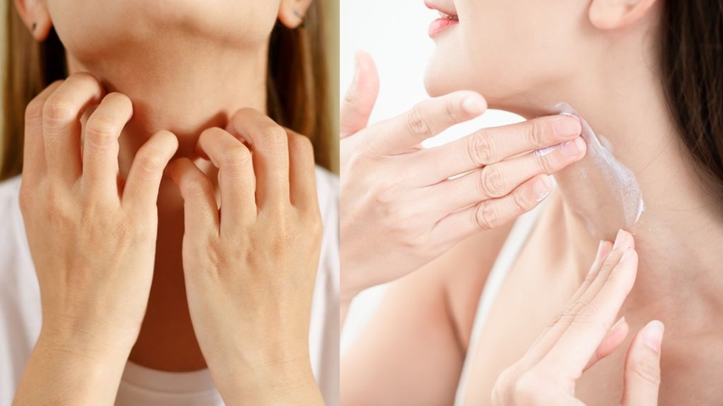 Atopic Derma Cream Lancopharm: Kem dưỡng ẩm cho người bị vẩy nến! 2