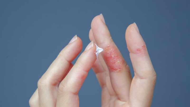 Atopic Derma Cream Lancopharm: Kem dưỡng ẩm cho người bị vẩy nến! 3