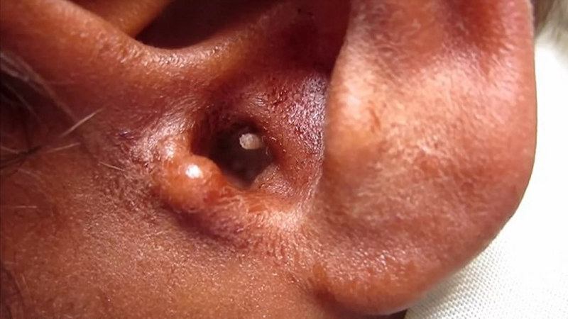 Ấu trùng ruồi maggot gây bệnh gì? Nguyên nhân, triệu chứng, chẩn đoán và cách điều trị bệnh