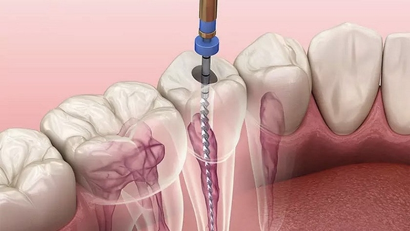 lay-chi-mau-rang-loi-ich-rui-ro-va-nhung-luu-y-can-nam 3