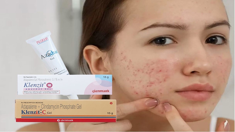 Azaduo và Klenzit C/MS kết hợp trị mụn được không? 4