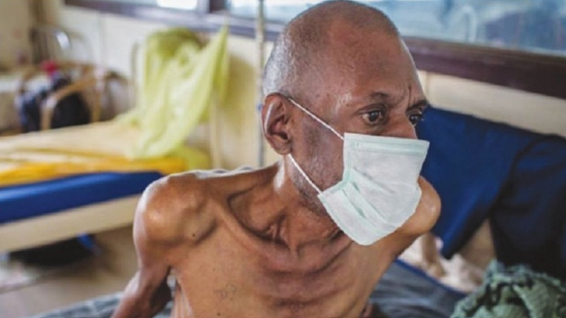 B20 là gì? Hiểu rõ về triệu chứng và biến chứng nguy hiểm của bệnh 2