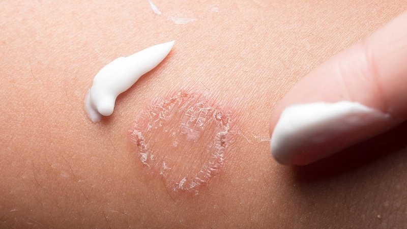 Bà bầu bị lác đồng tiền: triệu chứng và giải pháp 2