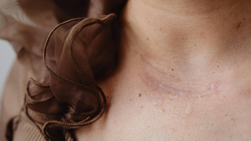 Dị ứng thường khiến ngứa lan tỏa kèm nổi mẩn hoặc mề đay