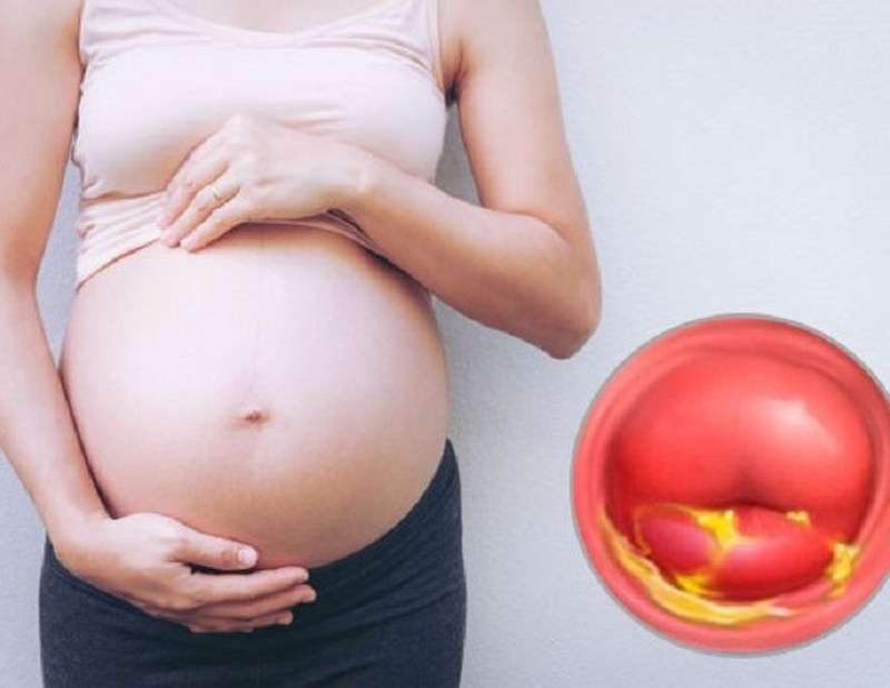 Nguyên nhân gây ra polyp cổ tử cung trong quá trình mang thai