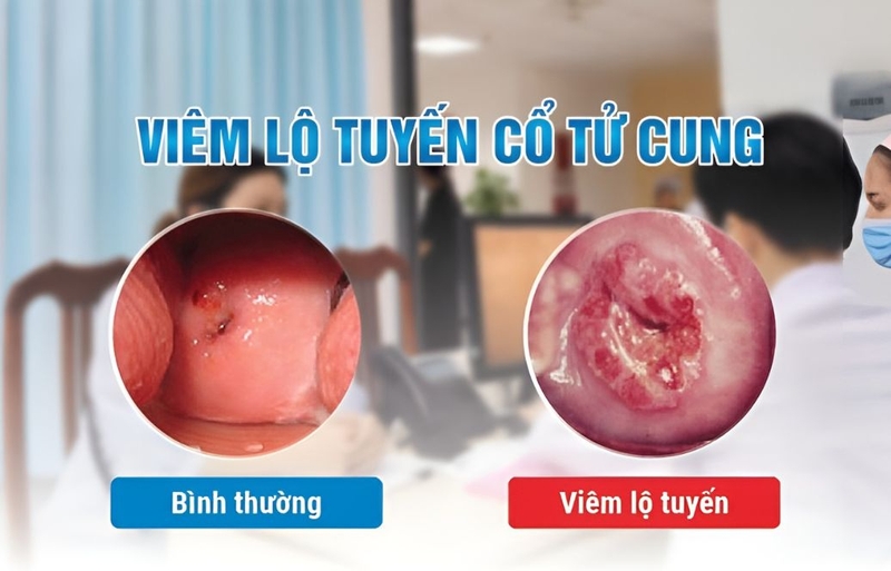 Bà bầu bị viêm lộ tuyến đẻ thường được không 1
