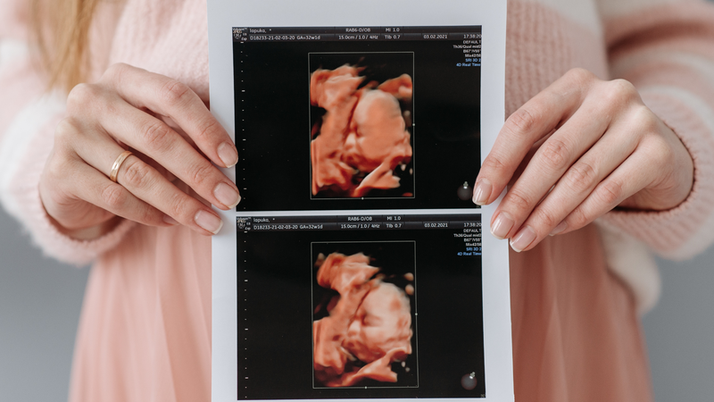 Bổ sung axit folic trong thai kỳ giúp giảm nguy cơ dị tật ống thần kinh ở thai nhi