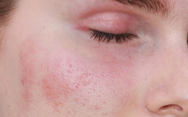 Bà bầu có được dùng thuốc mỡ Tetracyclin không và cần lưu ý những gì? 2