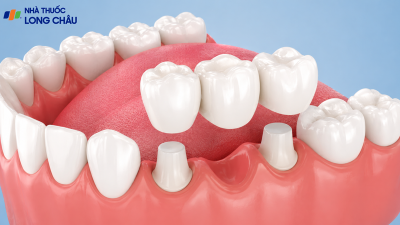 Độ bền của cầu răng sứ phụ thuộc răng trụ, vật liệu và cách chăm sóc
