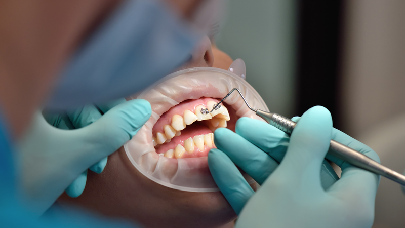 Vệ sinh kỹ và khám nha khoa định kỳ giúp cầu răng sứ duy trì lâu dài