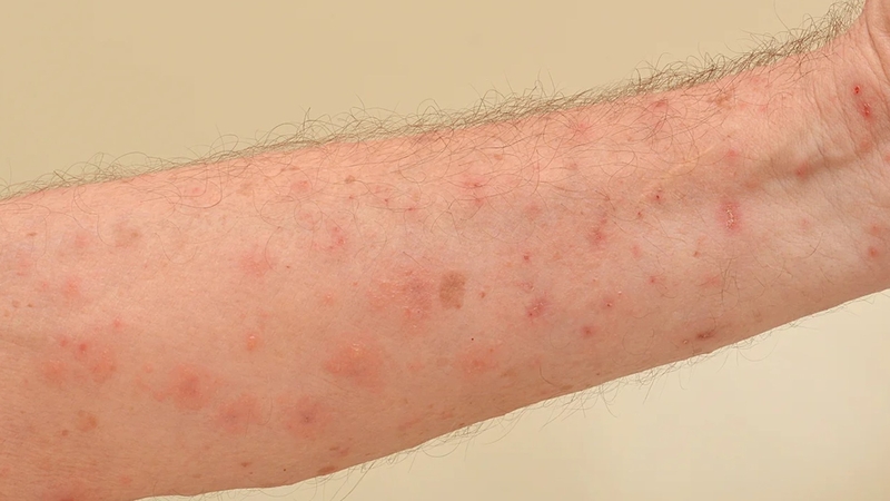 Bác sĩ giải đáp: Ghẻ nước có tự khỏi không? 1