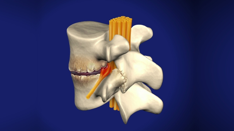 Bác sĩ giải đáp: Thoái hóa đốt sống cổ có nguy hiểm không? 1