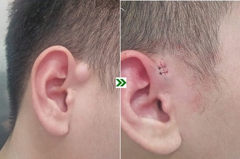 Phương pháp điều trị u bã đậu